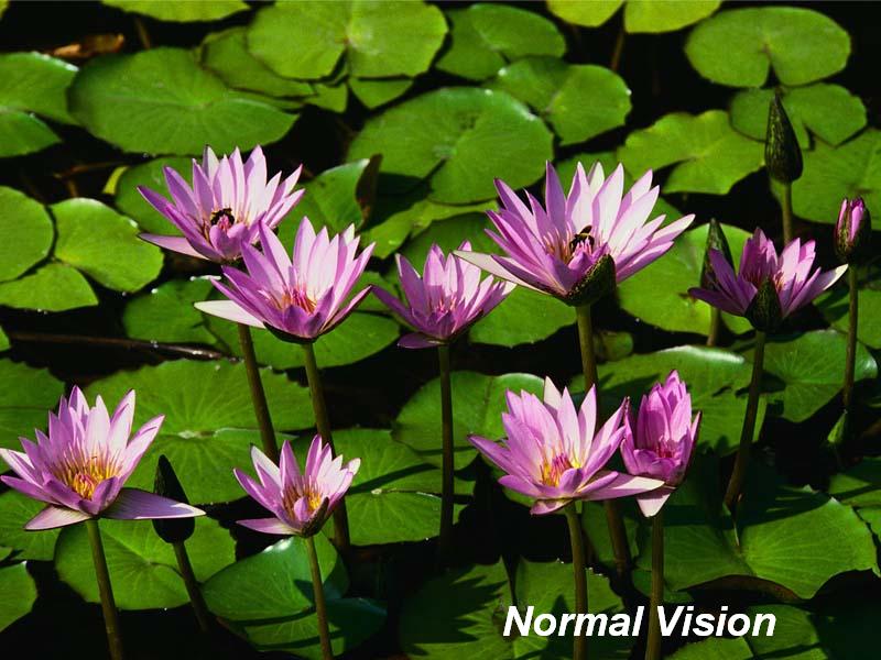 MRCP-Normal vision